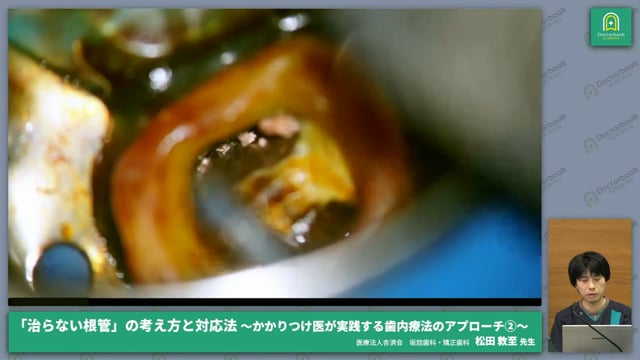 症例動画で見る開かない根管への治療アプローチ