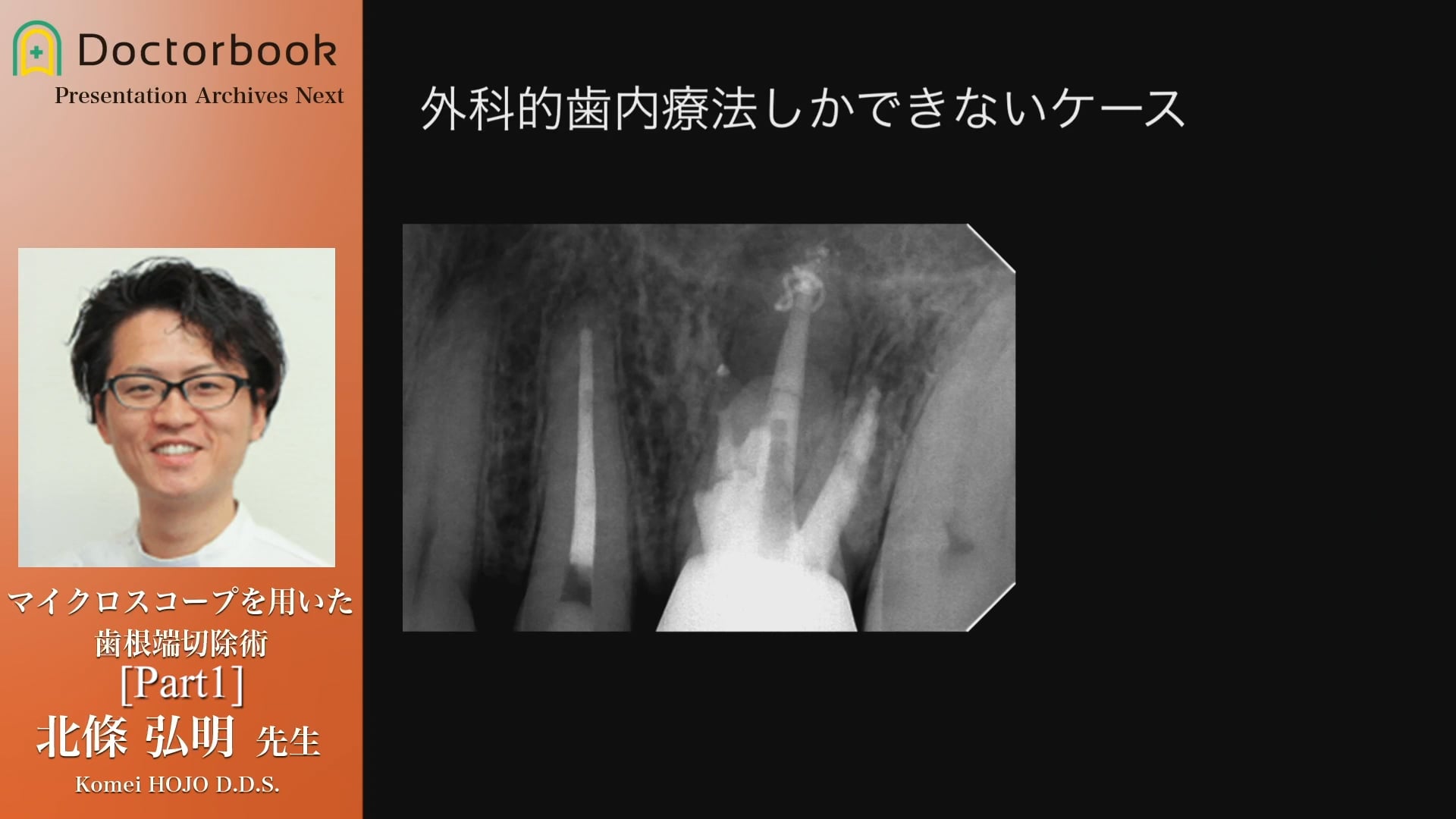 臨床知見録_マイクロエンド_歯根端切除の症例