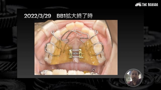 第1回 叢生・受け口を改善した症例