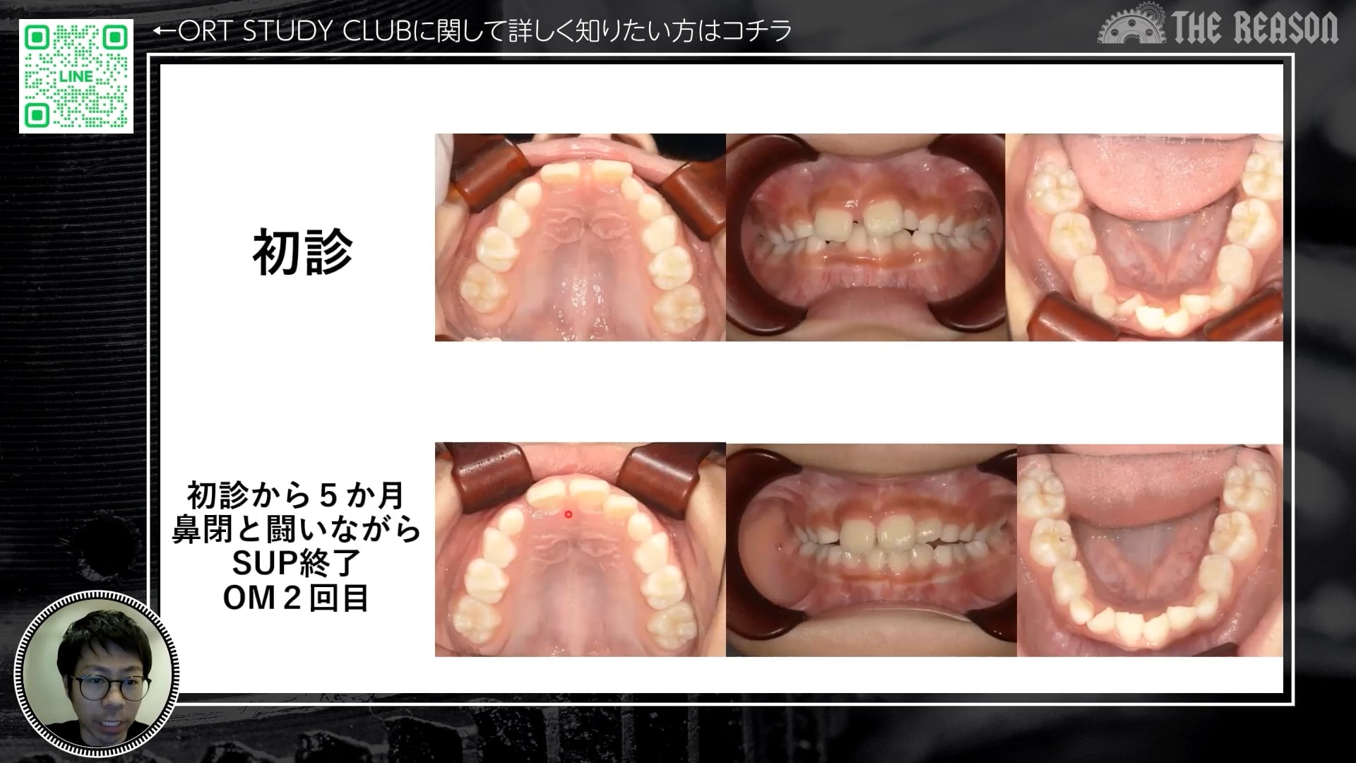 第2回 歯列不正・鼻閉のある症例