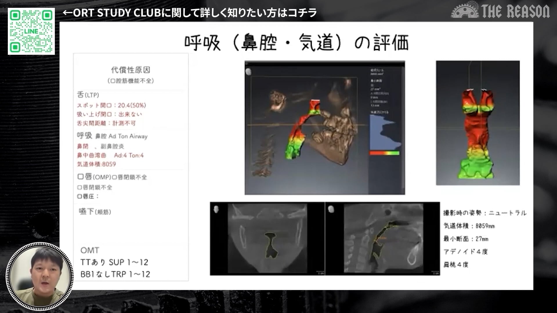 第3回 2級不正咬合の症例