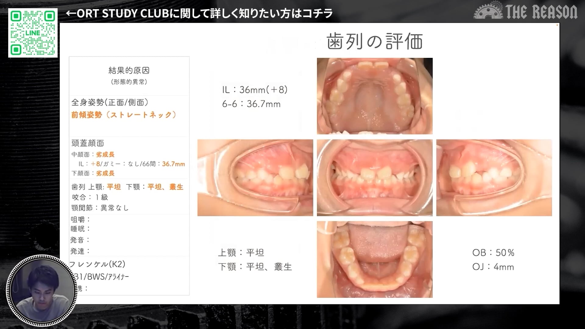 第4回 舌小帯に問題のある症例