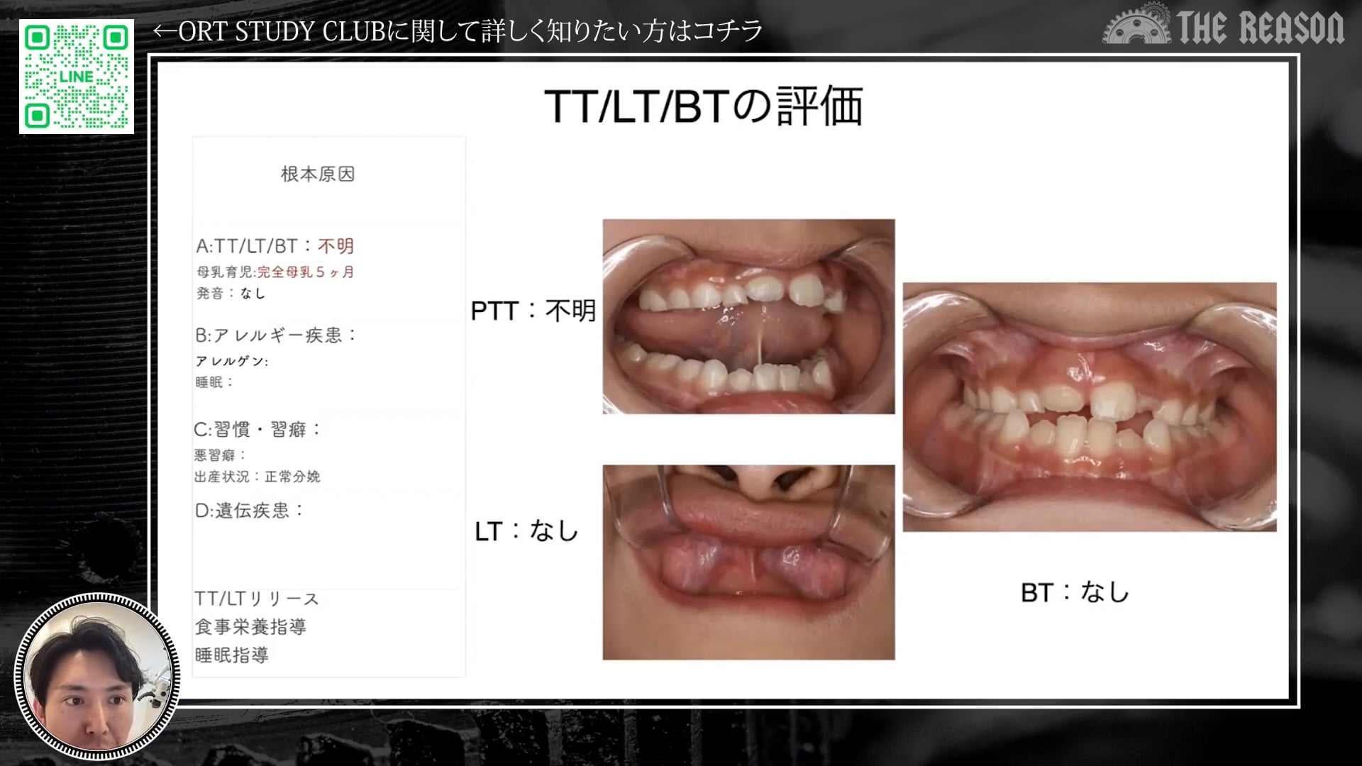 第5回 3級不正咬合の症例