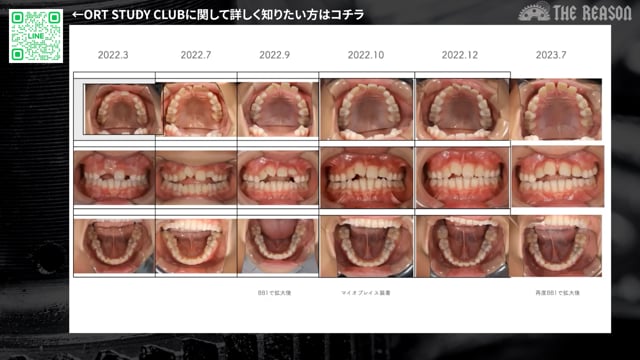 第6回 下顎叢生・ハート舌の症例