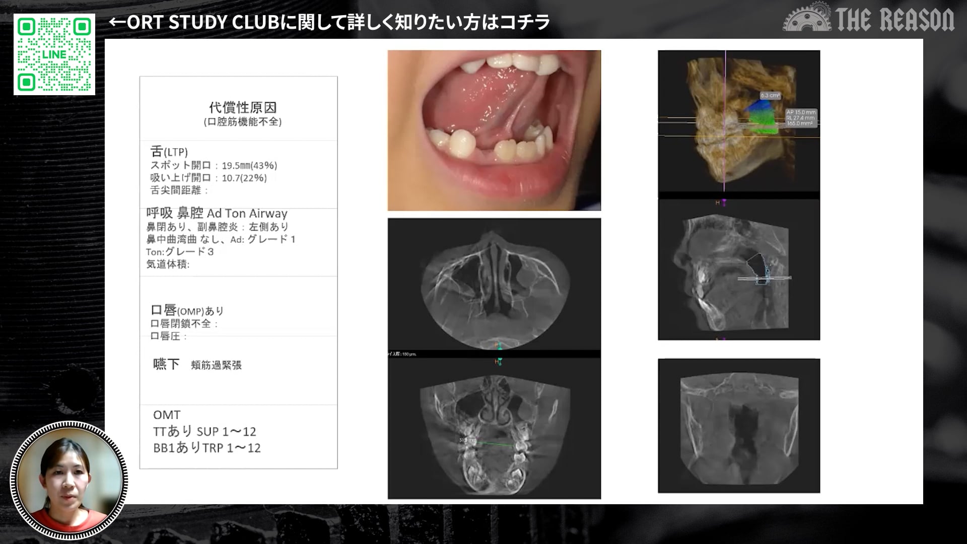 第7回 5歳お口ぽかんの症例・12歳不正咬合の症例