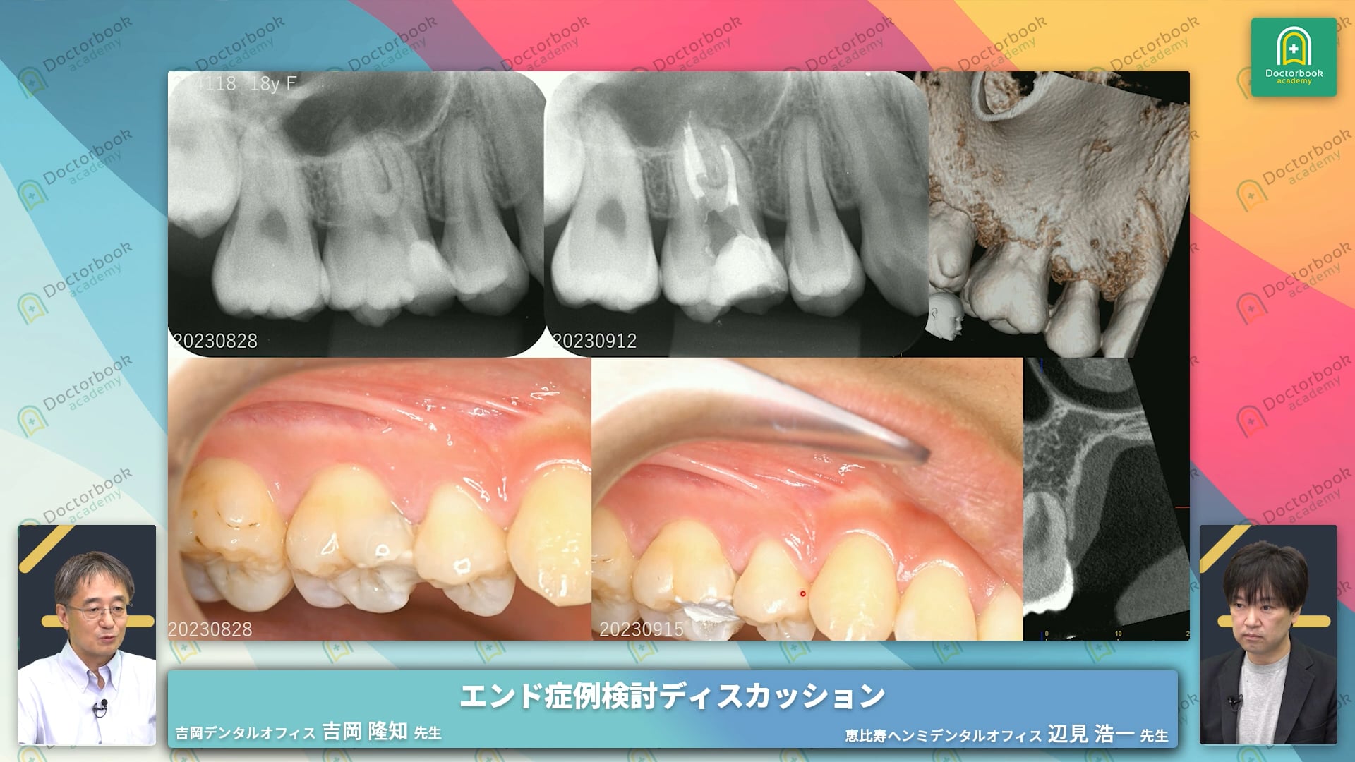 TPIC1：抜髄の治療選択　CASE1 上顎左側第一大臼歯抜髄症例