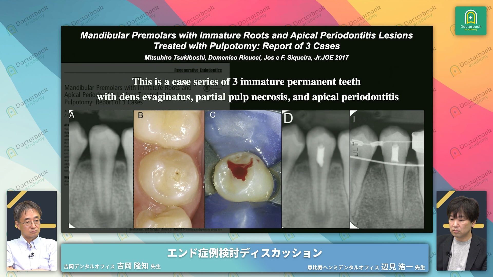 TOPIC3：歯頚部断髄の考え方