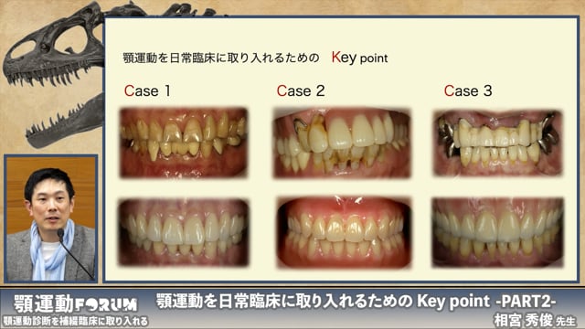 実症例から見る顎運動の治療活用│1.歯冠形態によるアプローチ、2.治療用義歯によるアプローチ、3.骨格性因子のある患者へのアプローチ