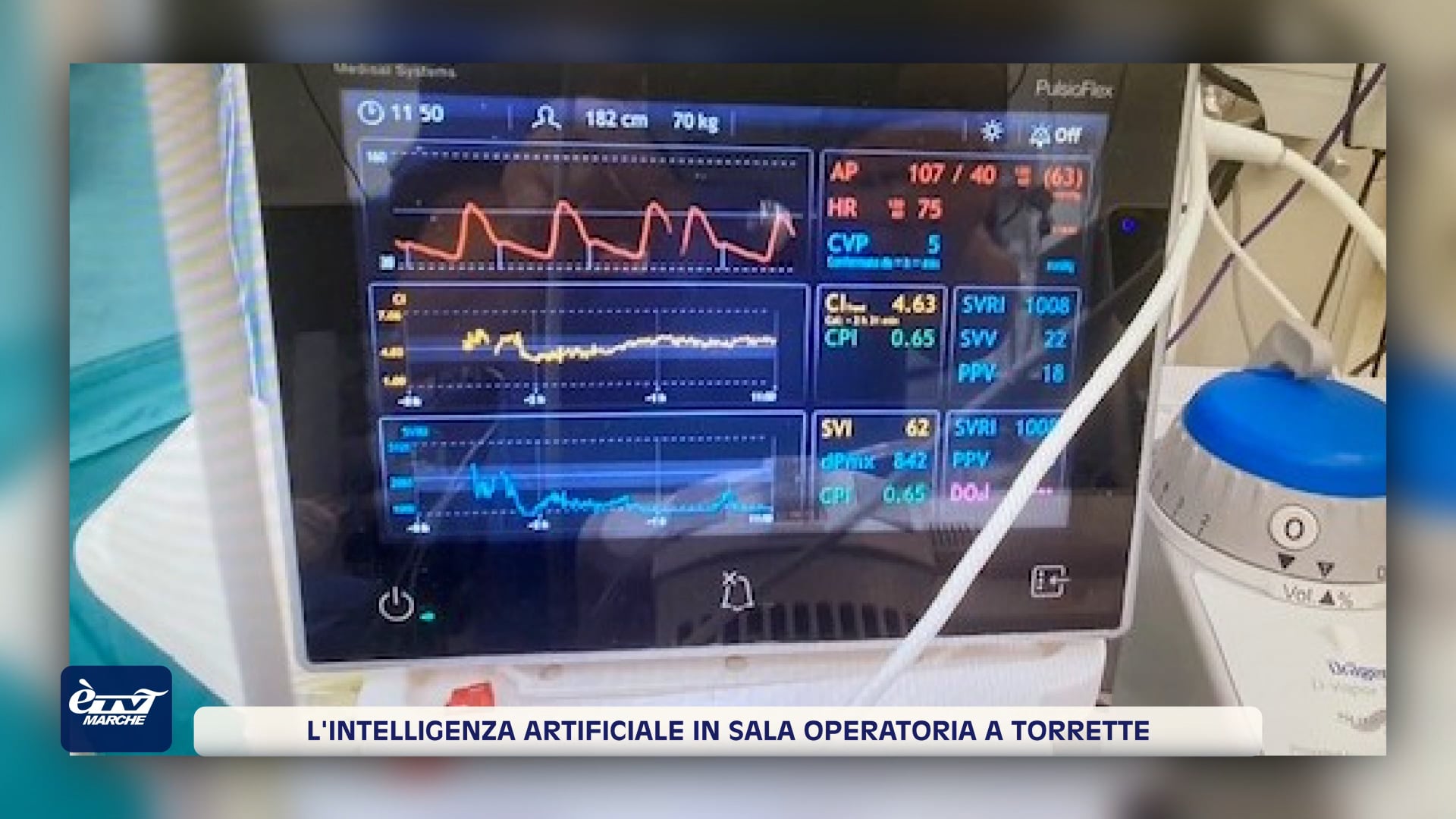 L'intelligenza artificiale in sala operatoria a Torrette - VIDEO