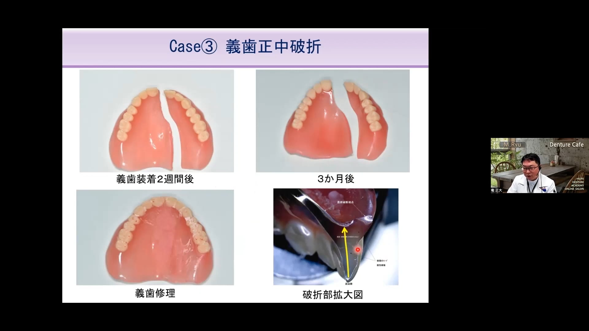 3Dプリントデンチャー 1年・2年半・3年使用症例からわかるメリット・デメリット│竜正大先生
