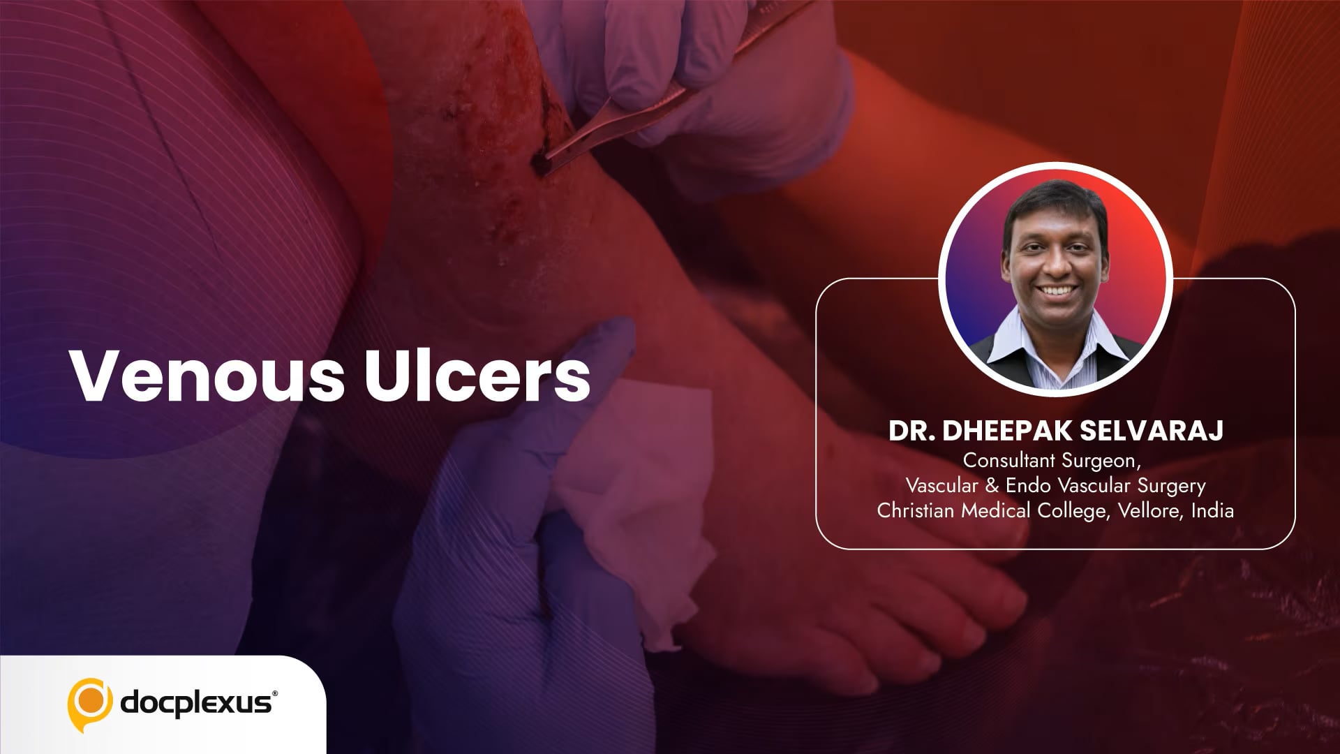 Venous Ulcer