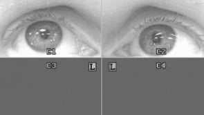 With Nystagmus