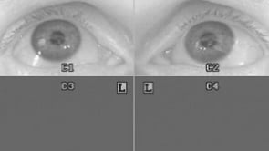 Without Nystagmus