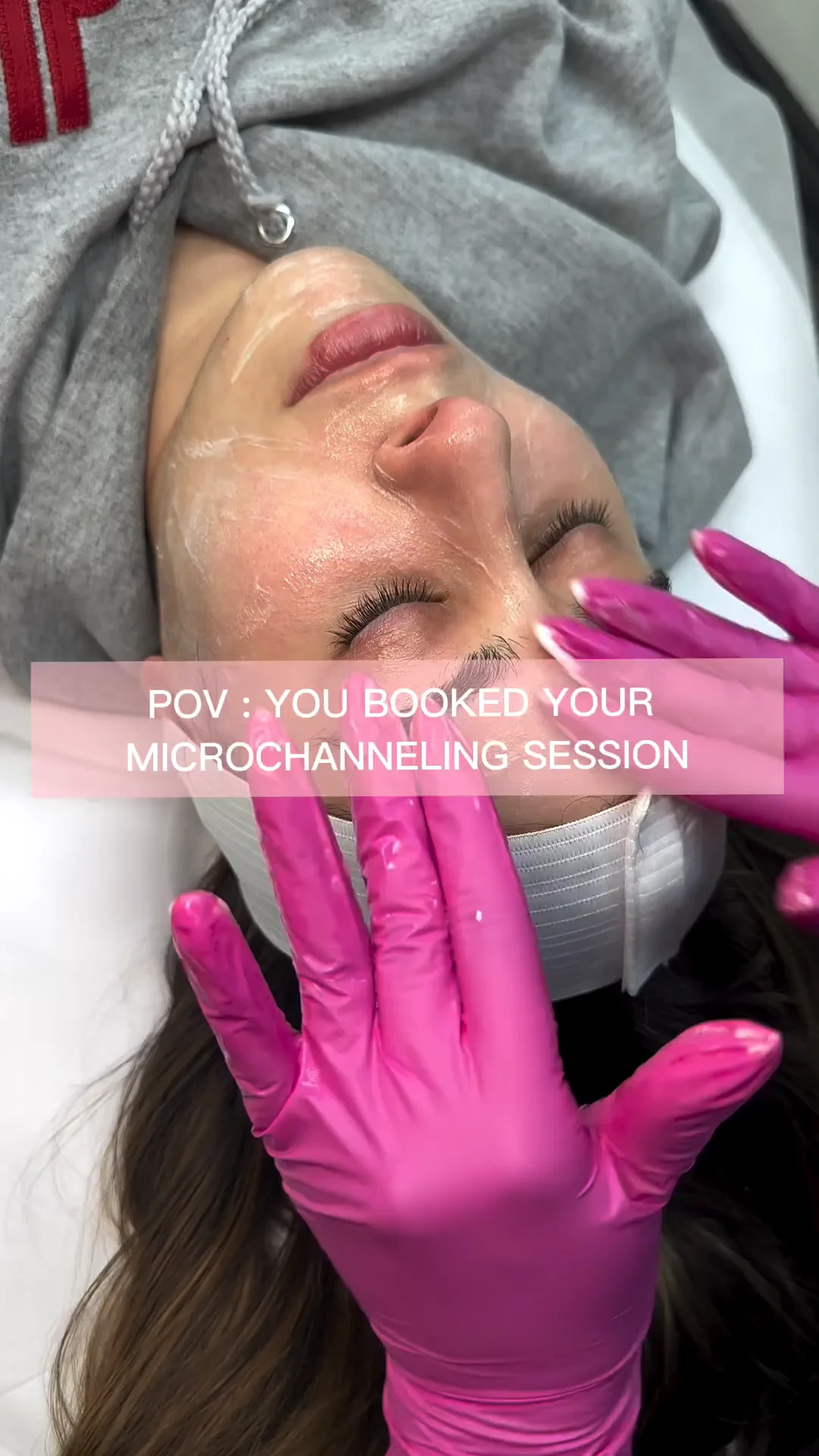 Microneedling Treatments In Mississauga, Toronto, Ontario on Vimeo