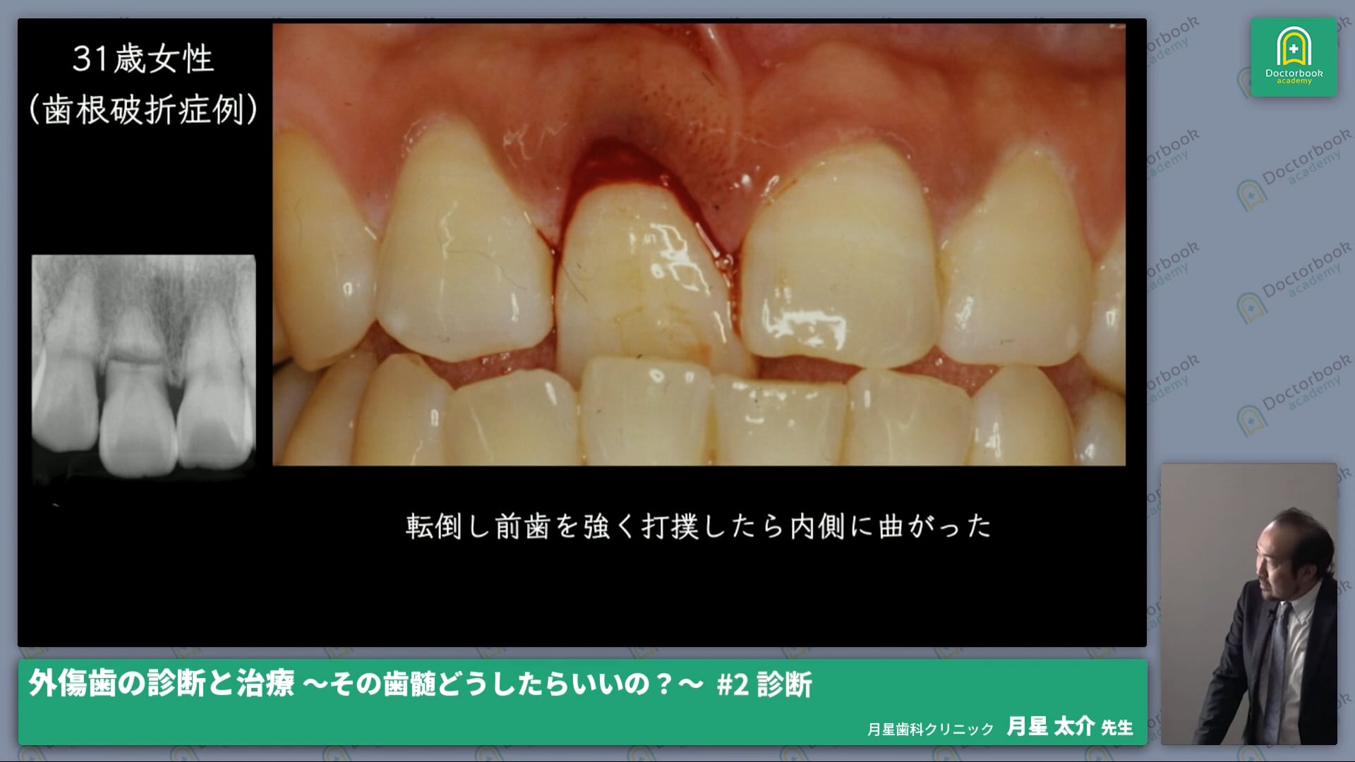 外傷歯の診断