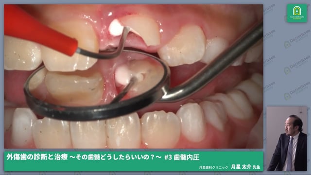 外傷歯の診断と治療～その歯髄どうしたらいいの？ | Doctorbook