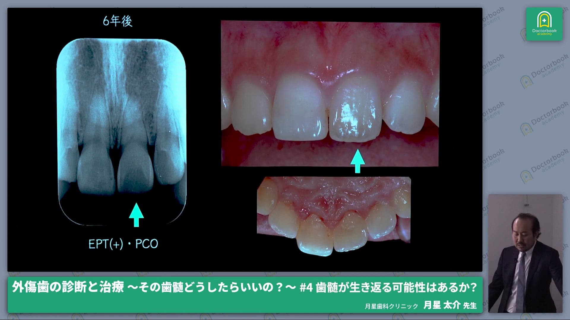 歯髄が生き返る可能性はあるか？