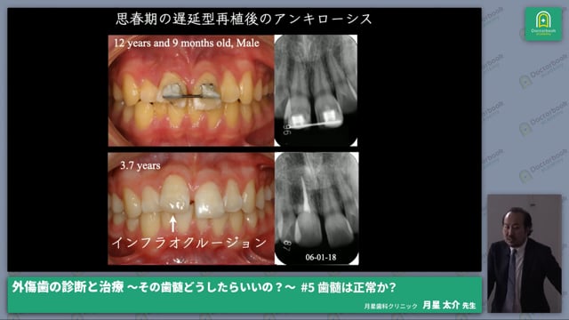 歯根膜は正常か？