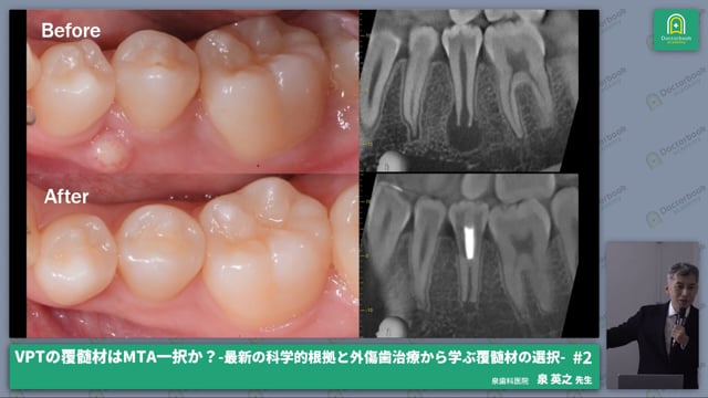 VPTの覆髄材に関する効率の良い文献の選び方・読み方