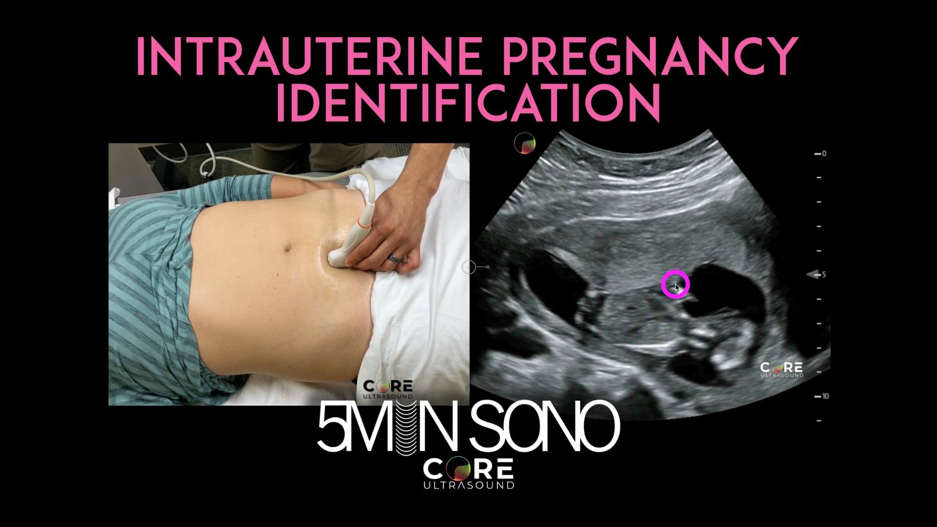 Image of 5 Minute Sono – Intrauterine Pregnancy Assessment