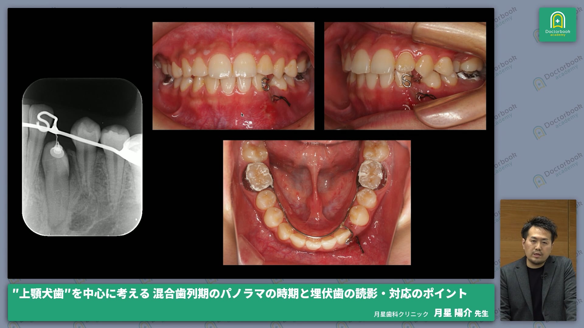 上顎犬歯を中心に考える 混合歯列期のパノラマの時期と埋伏歯の読影・対応のポイント