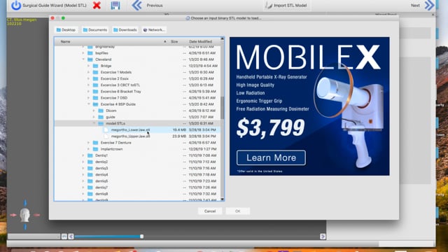Guided Implantology. Step-by-step Designing of surgical implant guides ...