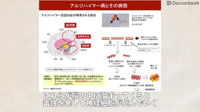 アルツハイマー型認知症について