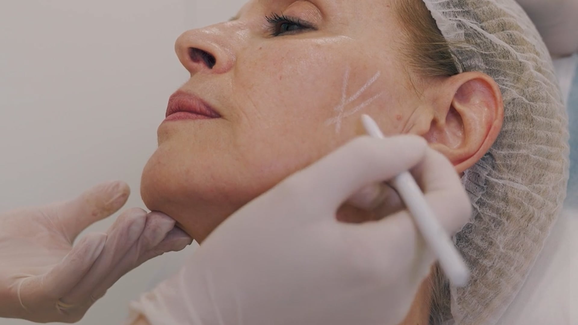 CORIUM DERMATOLOGIA | Injetáveis face