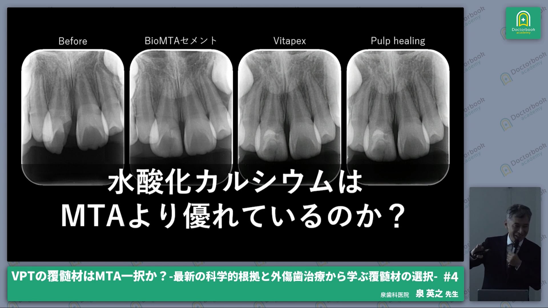 論文から導き出すVPT覆髄材の選択と外傷歯治療