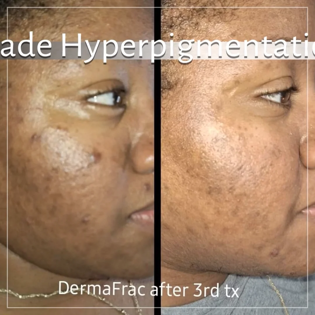 DermaFrac Revolutionary Suction Assisted Serum Infusing MicroChanneling