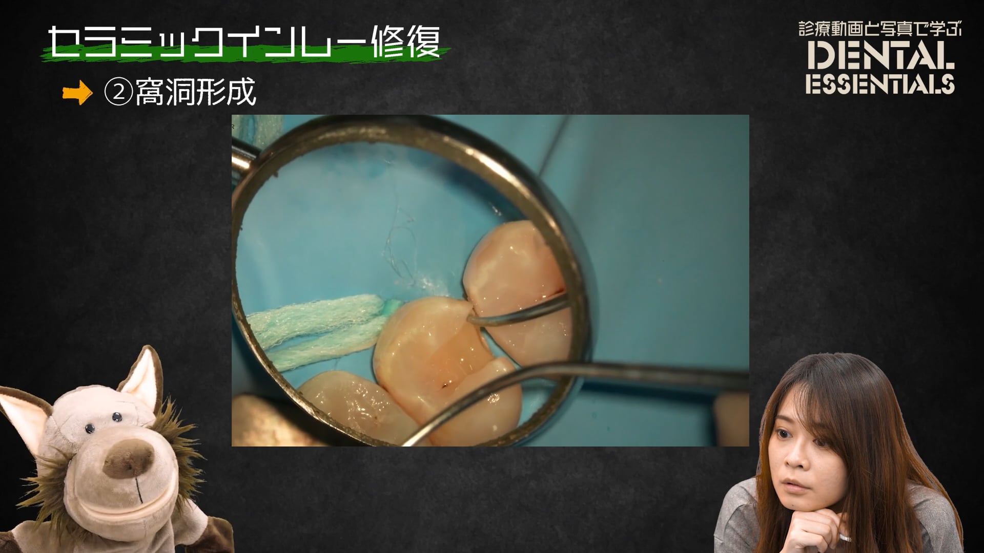 STEP2：窩洞形成│Dental Essentials vol.3 セラミックインレー修復