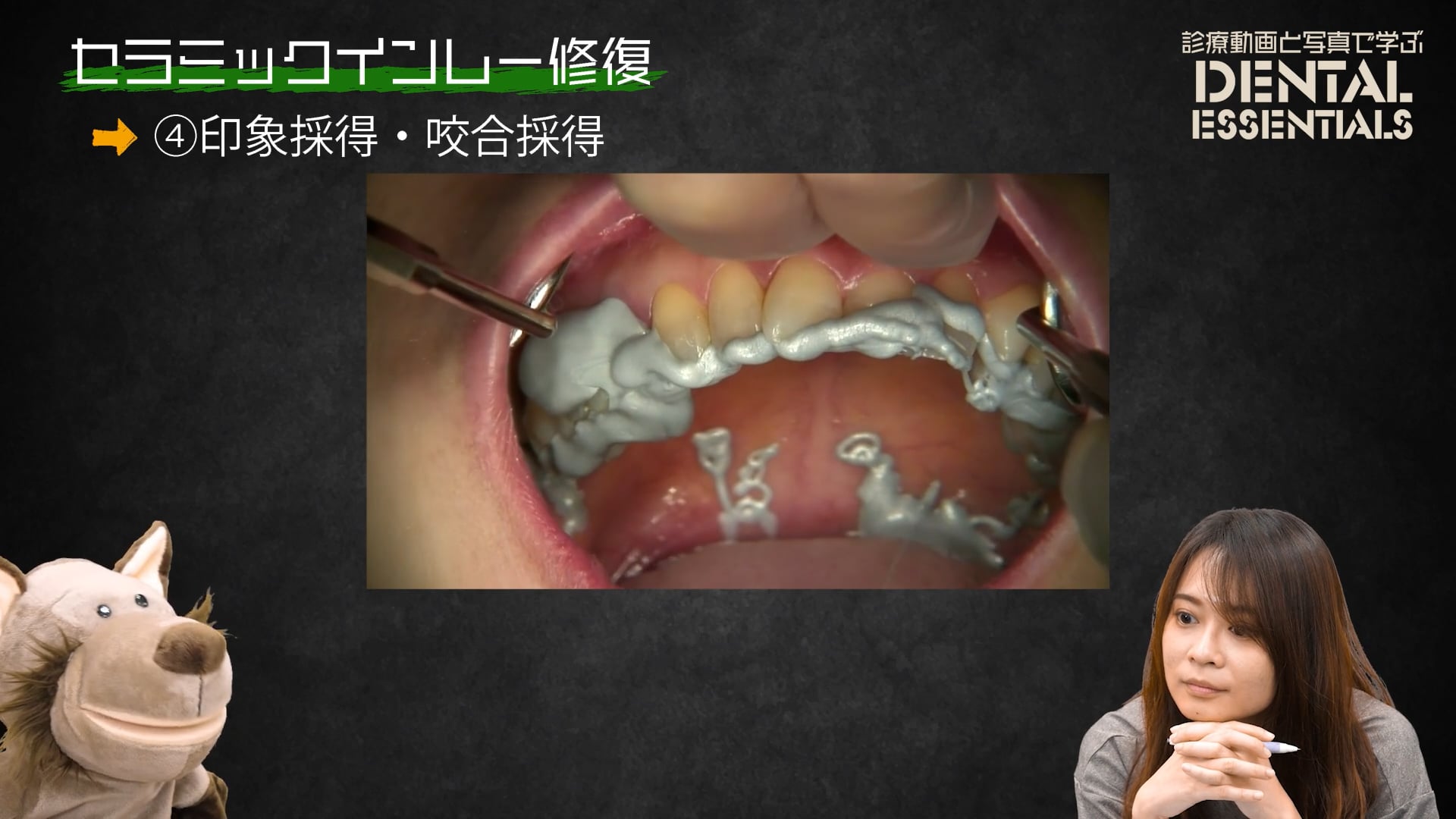 STEP4：印象採得・咬合採得│Dental Essentials vol.3 セラミックインレー修復