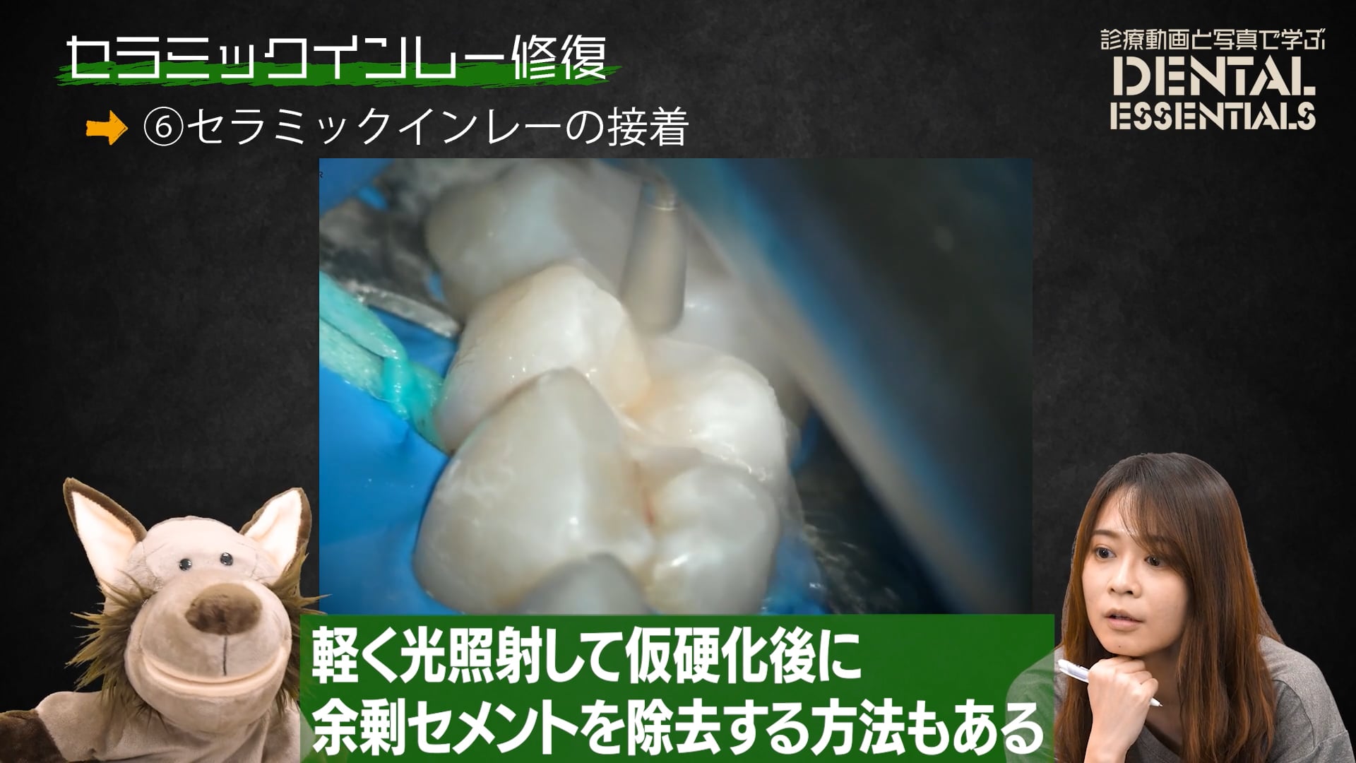 STEP6：セラミックインレーの接着│Dental Essentials vol.3 セラミックインレー修復