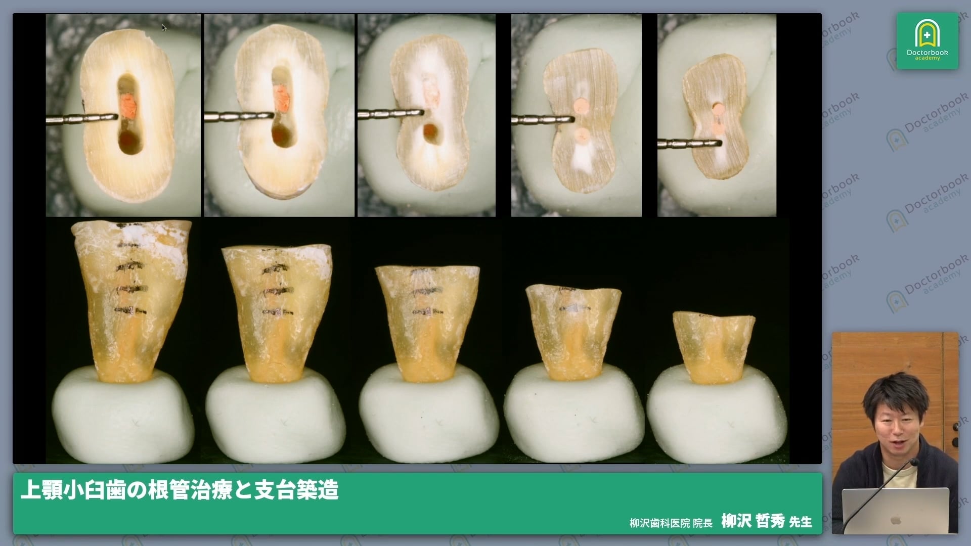 上顎小臼歯の根管治療と支台築造