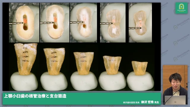 上顎小臼歯の根管治療と支台築造