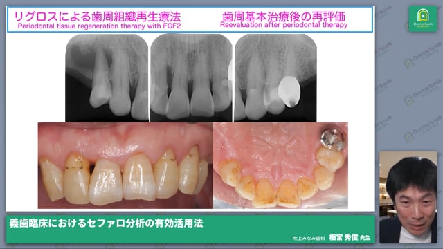 「義歯臨床におけるセファロ分析の有効活用法」