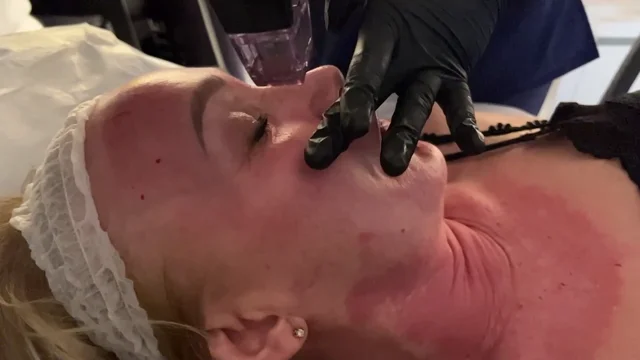 Best Morpheus8 Treatment in Leeds, UK