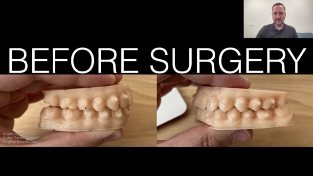 Ortho-Orthognathic Cases with Aligners