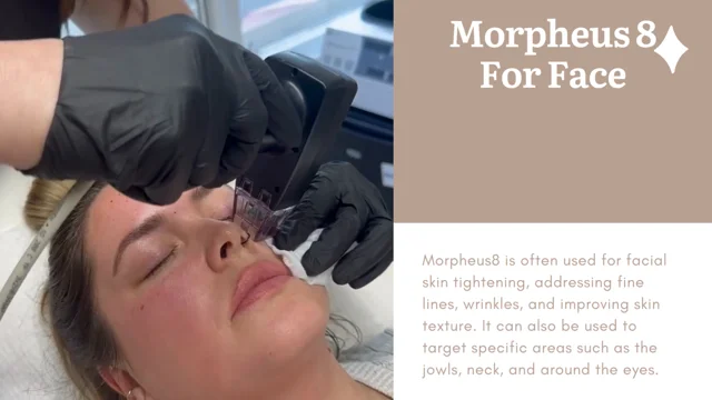 Buffalo hump treatment with Morpheus 8 - Hush LA Medspa