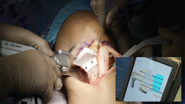 Proximal Tibia Anterior Closing Wedge Osteotomy with Revision Anterior Cruciate Ligament Reconstruction and Modified Lemaire Procedure Using Patient-Specific Instrumentation