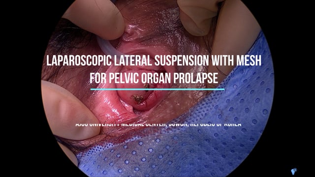 Uterine-sparing laparoscopic lateral suspension with mesh for the management of pelvic organ prolapse