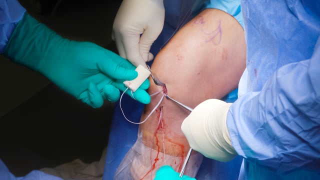 Physeal Sparing ACL Repair with BEAR Implant
