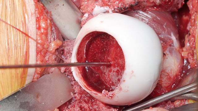 Surgical Hip Dislocation and Femoral Head Osteochondral Allograft Transplantation