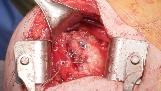 Modified McLaughlin Procedure for the Treatment of a Locked, Chronic Posterior Glenohumeral Dislocation