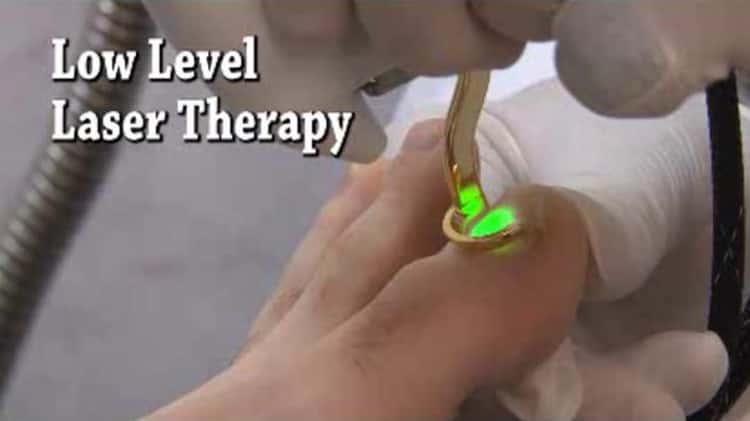 Laser Therapy for Foot Pain - Podiatrist in San Antonio, Live Oak