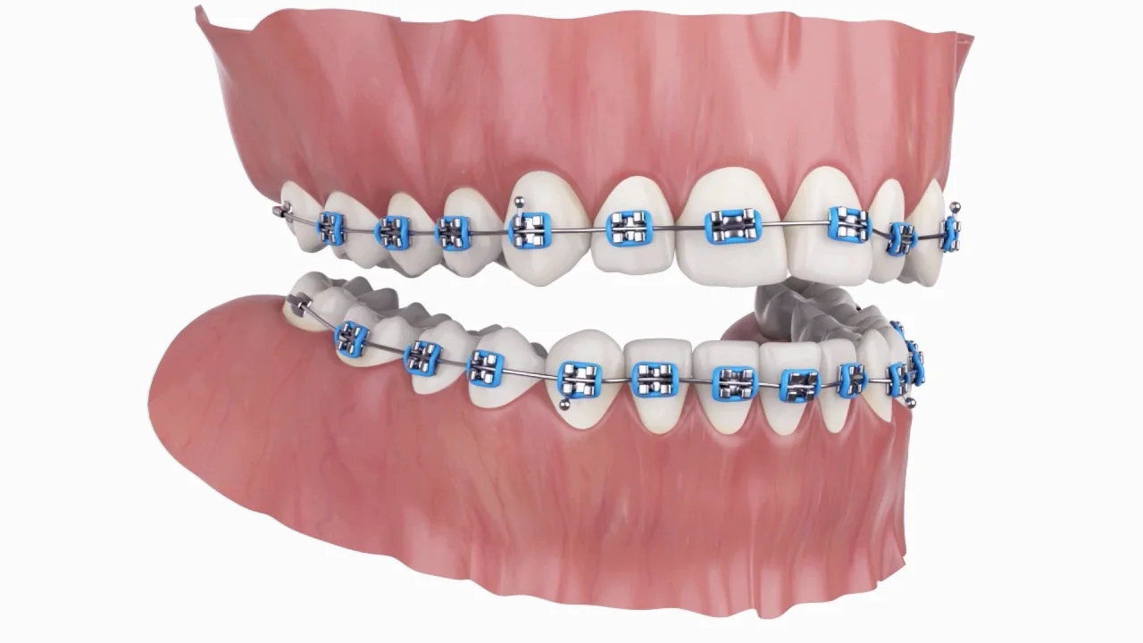 Braces Academy DIBS AI Consumer Video on Vimeo