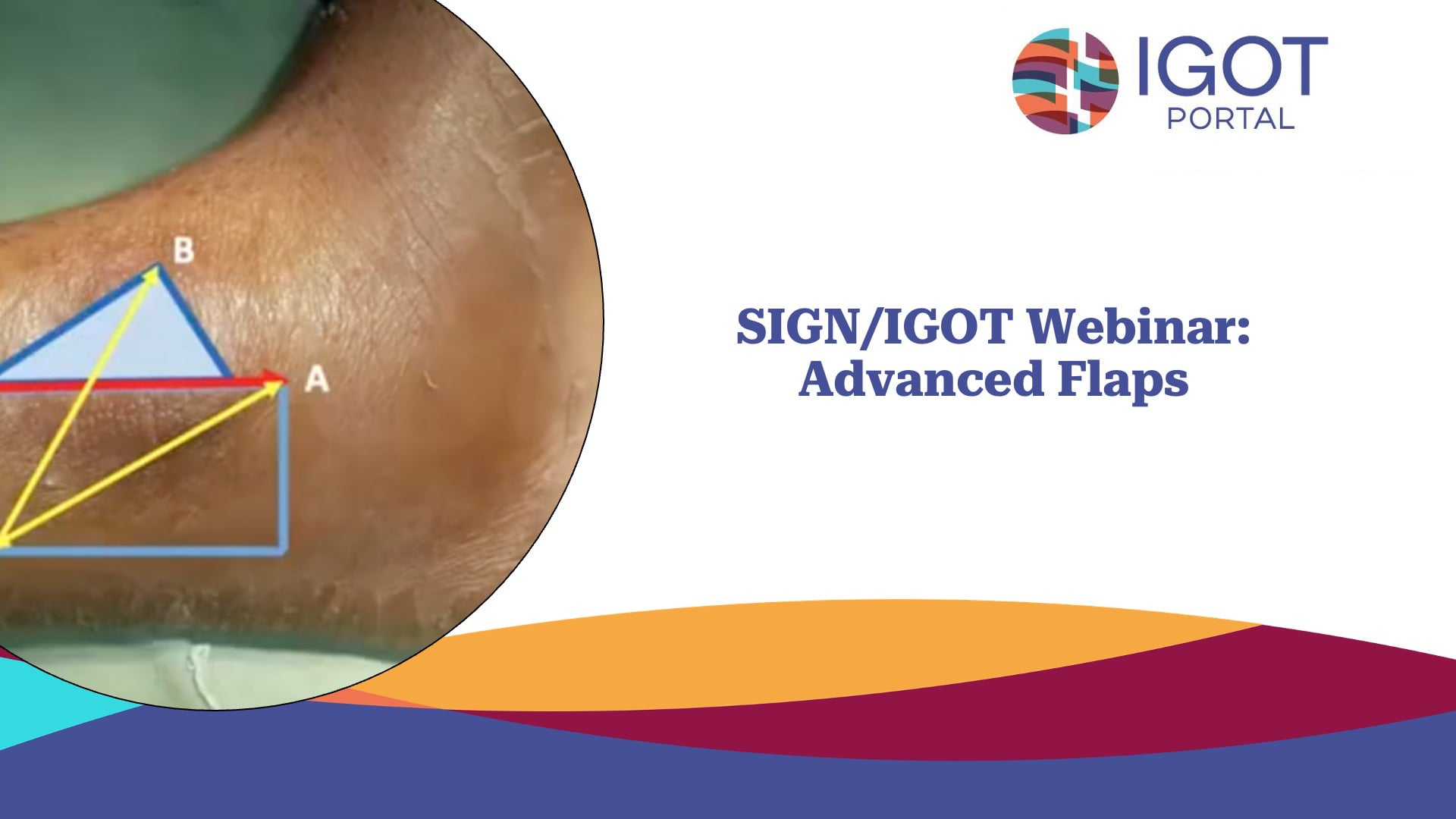 SIGN/IGOT: Advanced Flaps Webinar (8 27 21)