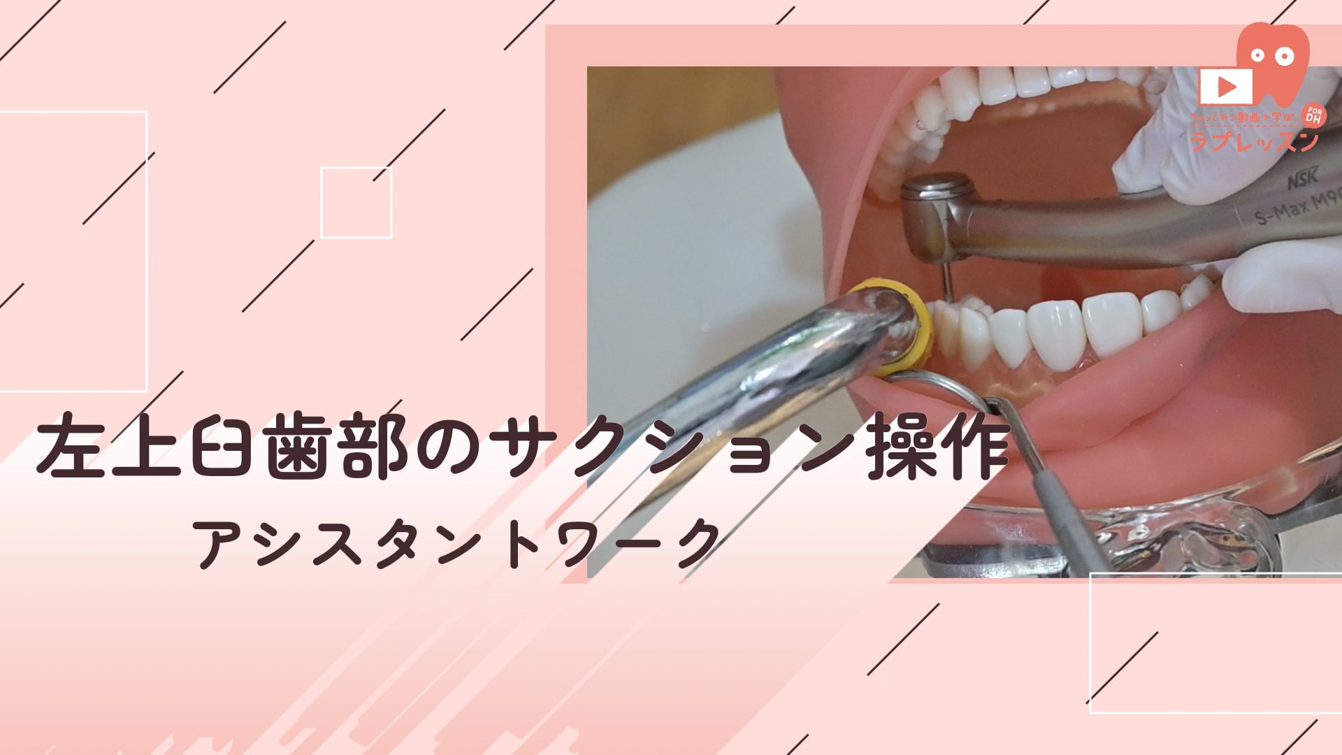 03.左上臼歯部のサクション操作