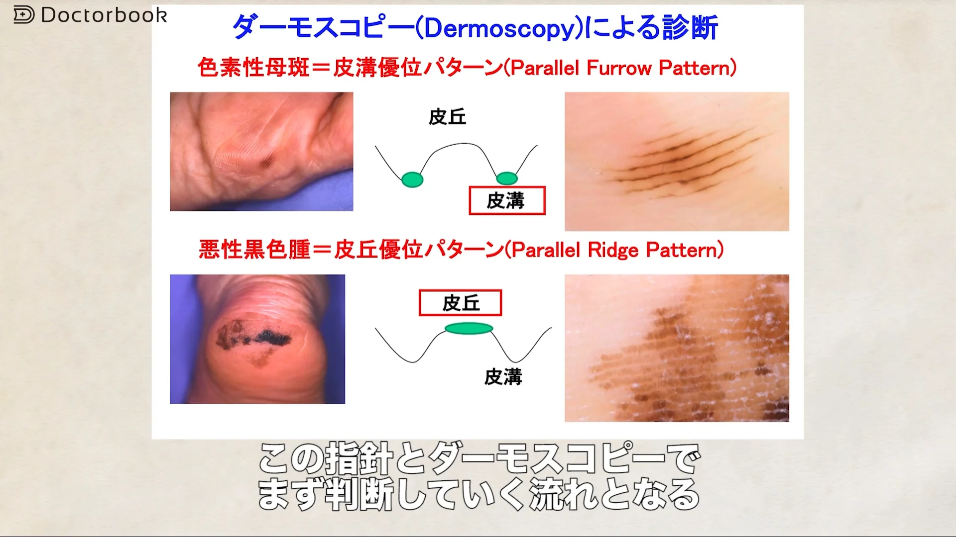 ほくろ 悪性 見分け 方 写真
