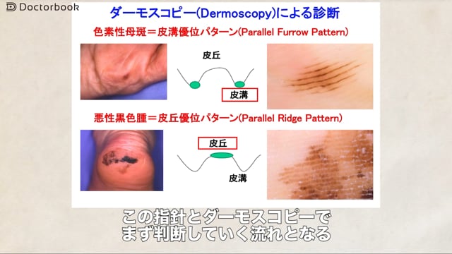 悪性黒色腫：疾患概要、診断、検査